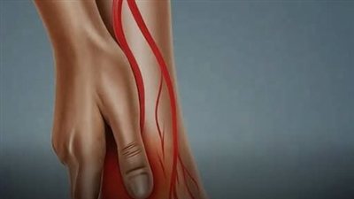 انسداد شرايين القدم حالة تصيب الأوعية الدموية التي تغذي الساقين والقدمين، يحدث بسبب ضيق الشرايين في الساقين ويتسبب في انخفاض تدفق الدم.. تعرف على المزيد