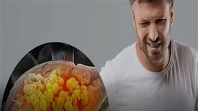 يرتبط مرض الكبد الدهني بارتفاع ضغط الدم، إلا أن العلاقة بين الحالتين معقدة.. تعرف على المزيد