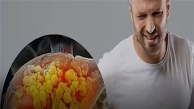 يرتبط مرض الكبد الدهني بارتفاع ضغط الدم، إلا أن العلاقة السببية بين الحالتين غير واضحة.. 