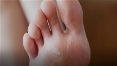 تقشر الجلد بين أصابع القدم في الصيف.. هل هو فطريات؟ إليك الأسباب وطرق العلاج