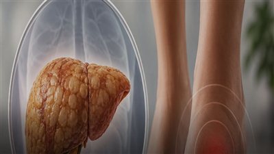 علامات قد تشير إلى الإصابة بالكبد الدهني.. لا تتجاهلها