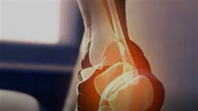 ارتفاع الكوليسترول.. علامات قد تظهر في القدمين لا ينبغي تجاهلها