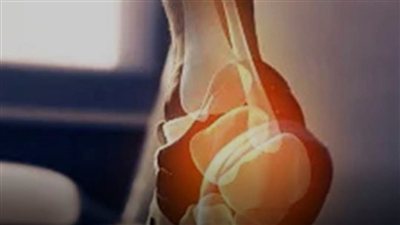 علامات ارتفاع الكوليسترول قد تظهر في القدمين.. لا تتجاهل هذه الإشارات