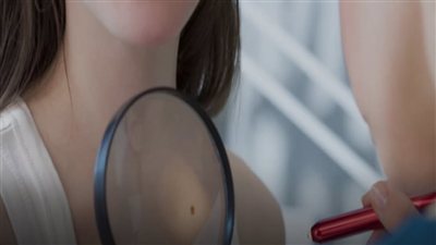 تليف الكبد.. 5 علامات قد تظهر على الجلد لا تتجاهلها