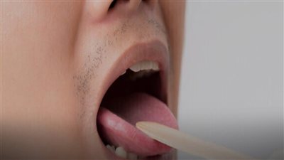 سرطان القولون.. علامة قد تظهر في الفم لا تتجاهلها
