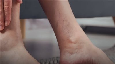 انسداد شرايين الساقين يظهر أثناء الوقوف.. 5 علامات قد لا تنتبه لها