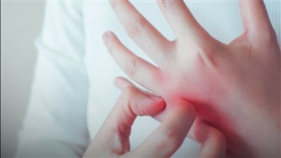 ارتفاع حمض اليوريك يظهر في اليدين.. 4 إشارات مبكرة انتبه إليها