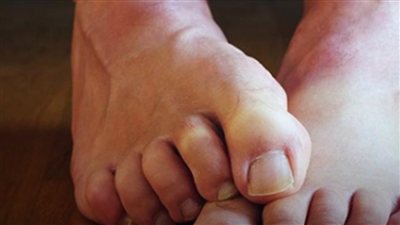 ارتفاع الكوليسترول يرسل تحذيرات إلى القدمين.. 5 تغيرات قد تغفل عنها