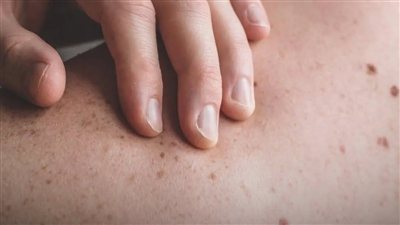 الكبد الدهني يظهر في الجلد أولًا.. 5 إشارات صامتة انتبه إليها
