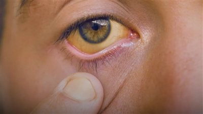 الكوليسترول قد يترك أثرًا حول العين.. تغيرات تستحق الملاحظة انتبه إليها