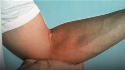 ألم المفاصل صباحًا.. متى يكون علامة تستحق الانتباه؟
