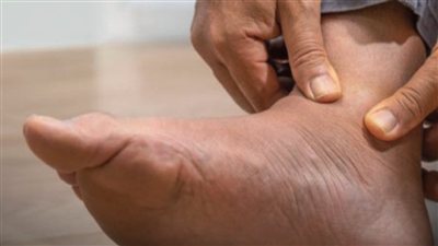 ضعف عضلة القلب.. تورم القدمين قد يكون إشارة مهمة