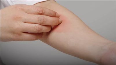 الحكة المستمرة.. متى يمكن أن تكون مرتبطة بمشكلة داخلية؟