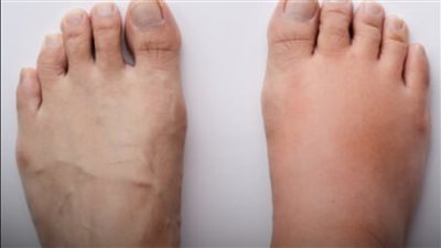 أسباب تورم القدمين بعد الجلوس لفترة طويلة.. هل يستدعي زيارة طبيب؟