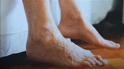 السكري يترك رسائل في القدمين.. 5 تغيرات لا يلاحظها كثيرون