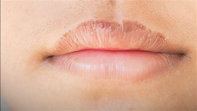 جفاف الفم المستمر.. 5 إشارات قد تكشف ما وراءه