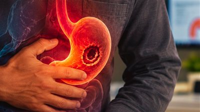 قرحة المعدة.. 6 علامات تحذيرية وأسباب الإصابة وأفضل طرق العلاج