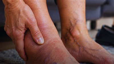 أعراض أمراض القلب في القدمين.. 3 علامات انتبه إليها