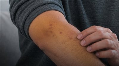 تظهر على الجلد.. 6 أعراض لأورام البنكرياس احذرها
