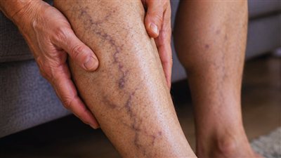 الكوليسترول يترك علامات على الساقين.. تغيرات بسيطة تستحق الانتباه