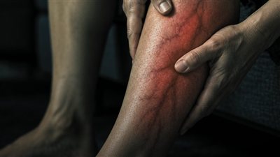 6 علامات تحذيرية على الجسم.. جلطات الدم قد تتحرك إلى الرئة