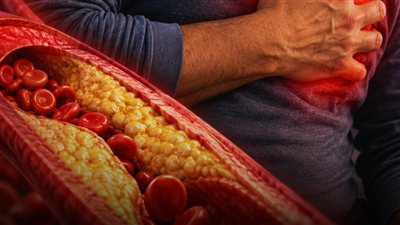 وداعًا للكوليسترول حسام موافي.. طرق طبيعية تساعد على علاجة